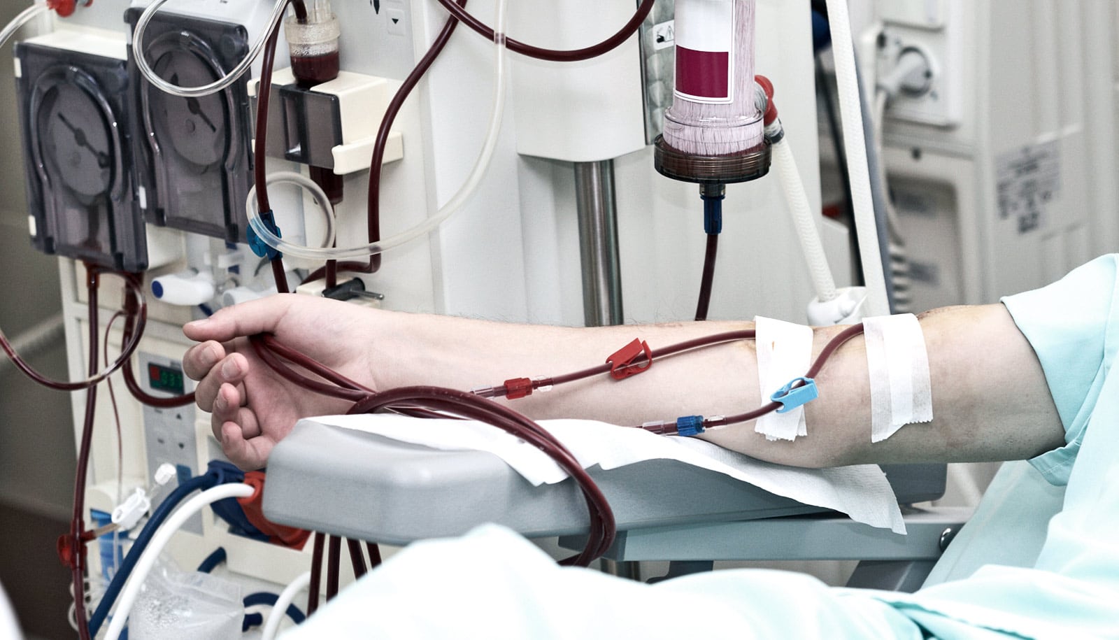 Плазмаферез При Ревматоидном Артрите — Buy-artox.ru