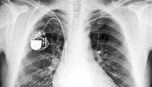 X-ray of patient with pacemaker