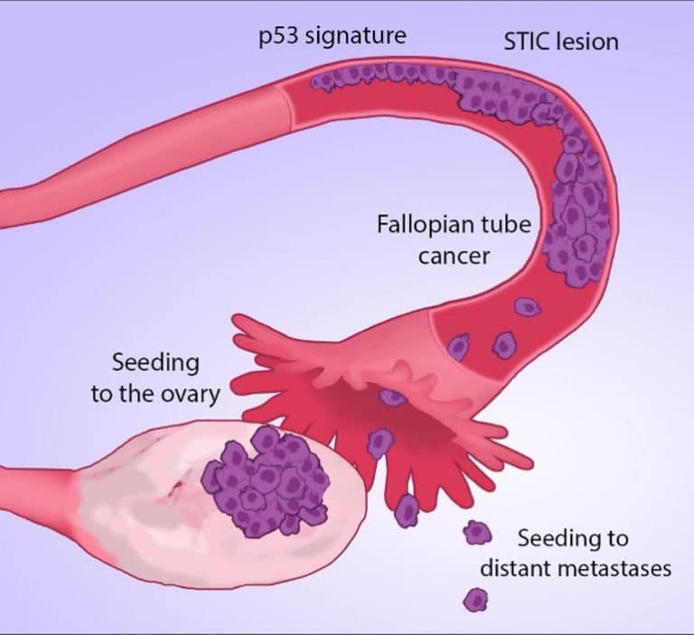 ovarian-cancer-diagnosis