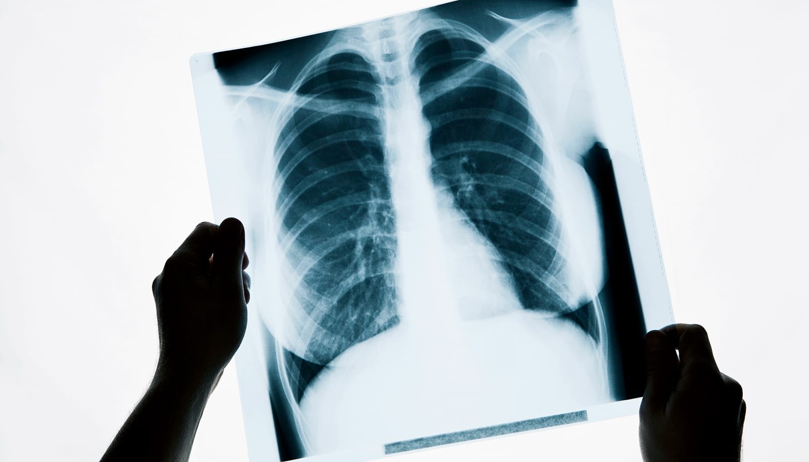 Algorithm outdoes radiologists at spotting pneumonia in X-rays - Futurity