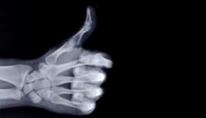 x-ray thumbs up