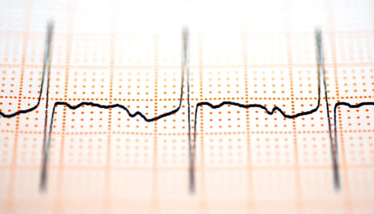 ecg readout - sinus node concept