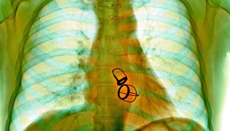 x-ray shows ribs and dark shapes of artificial heart valves
