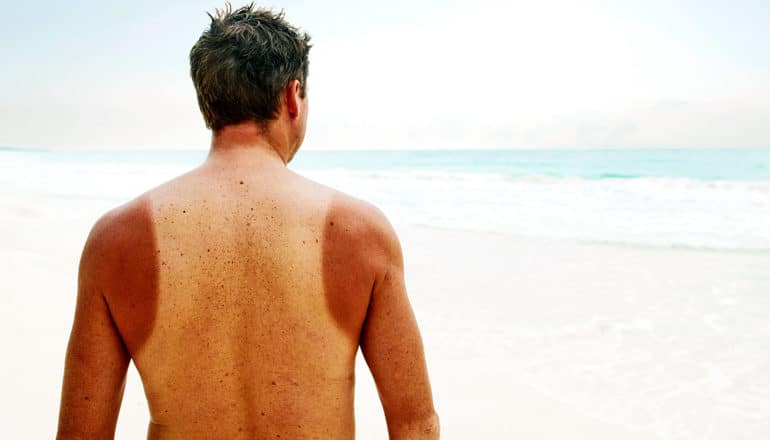 A man with sun-damaged skin on his back and arms looks out to the ocean from the beach