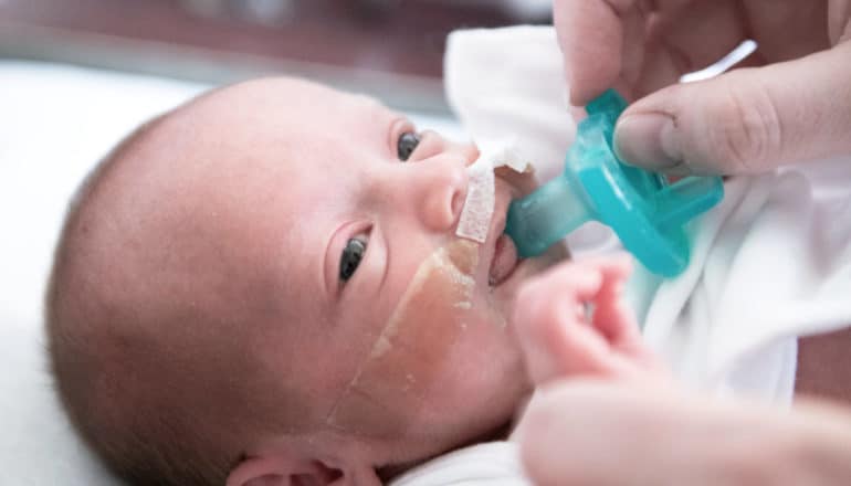 baby with medical tape on face receives pacifier