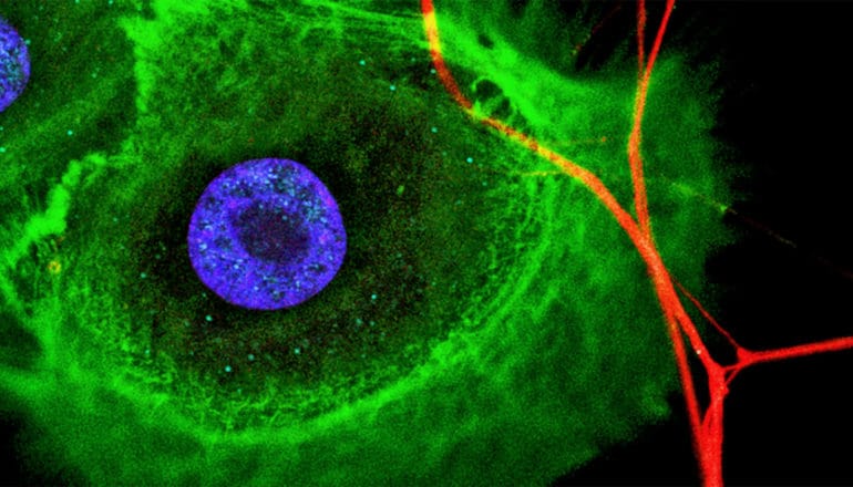 The cancer cells are a large green blob, with a blue circle in its center. There are wisps of red touching the green mass, all set against a black background