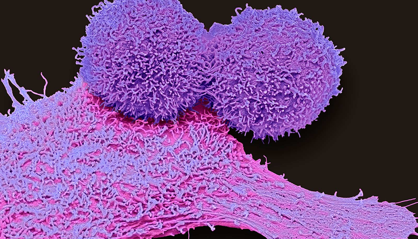 Why Triple Negative Breast Cancer Is Bad