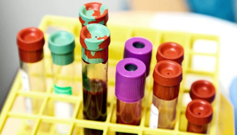 Blood test vials sit in a yellow rack