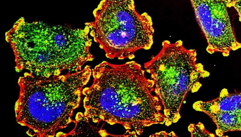 Melanoma cells show up blue, green, and red against a black background