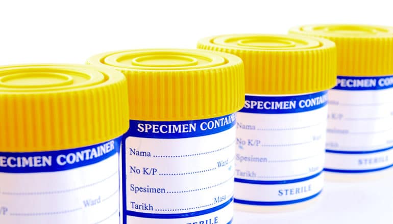 A row of urine sample cups with yellow lids sit on a white background