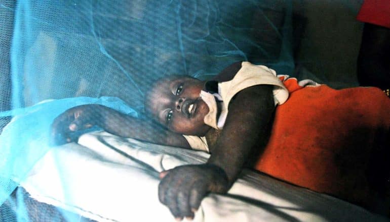 A young boy lays in bed under a bright blue malaria net