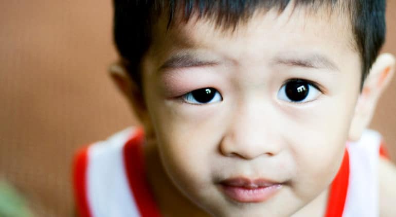 overhead image of toddler with swollen eyelid