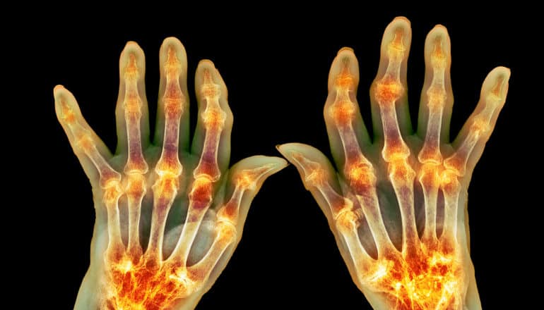 x-ray of arthritic hands with red at joints