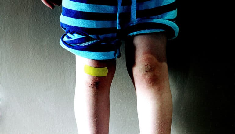 A child's knees are scraped up, with a yellow bandaid on one knee