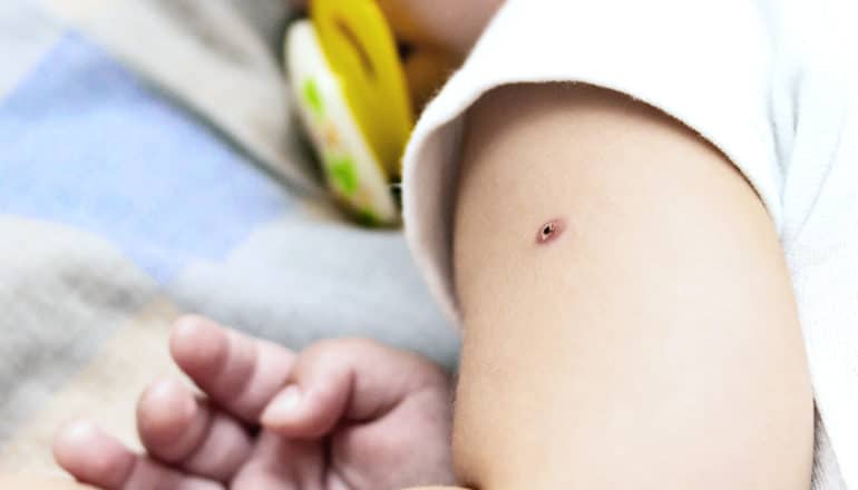 A baby has a mark from a vaccine on their arm