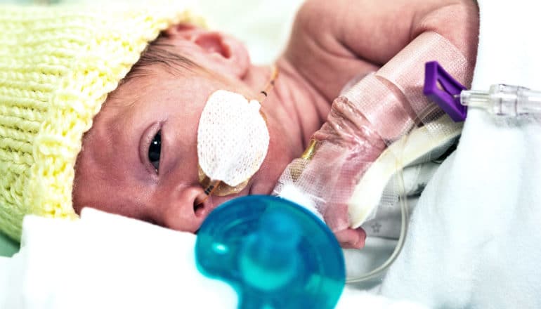 A premature baby is connected to medical equipment