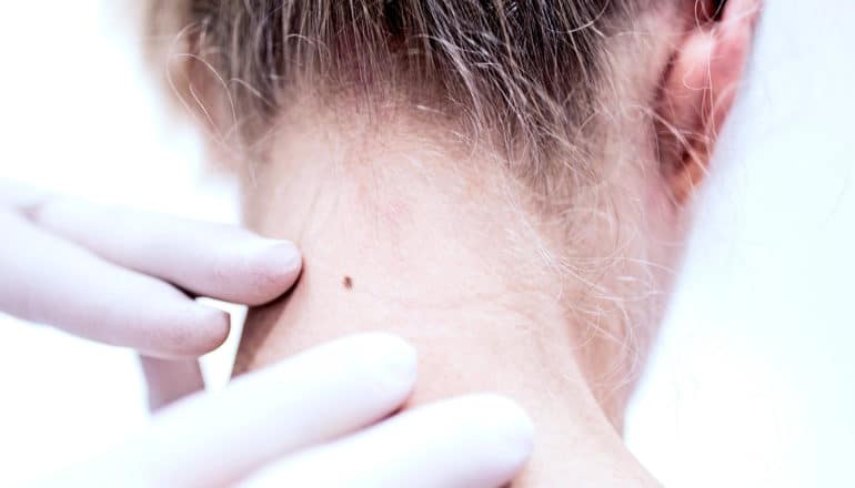 A doctor examines a mole on a woman's neck