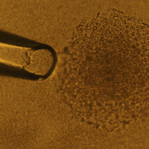 A pipette captures a single cancer cell