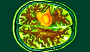 A CT scan of a brain shows a glioblastoma