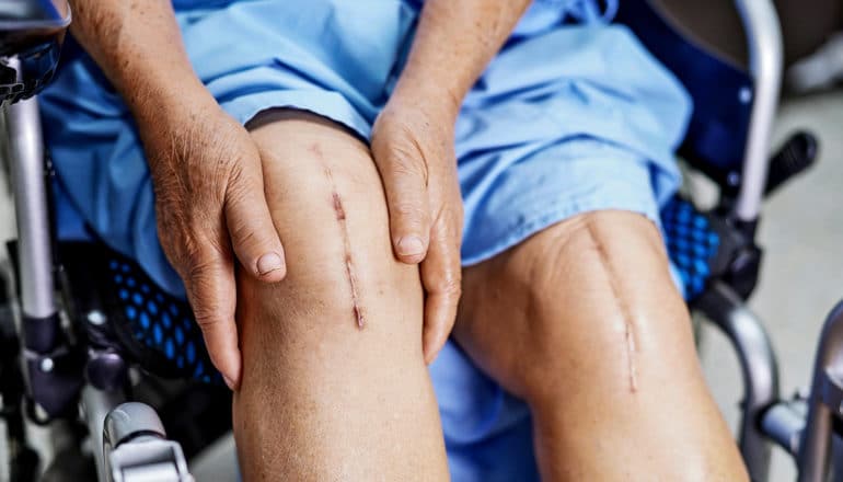 A knee replacement patient holds their right knee while in a wheelchair