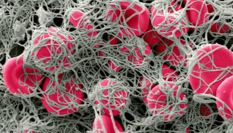 gray fibrils on cluster of pink blood cells