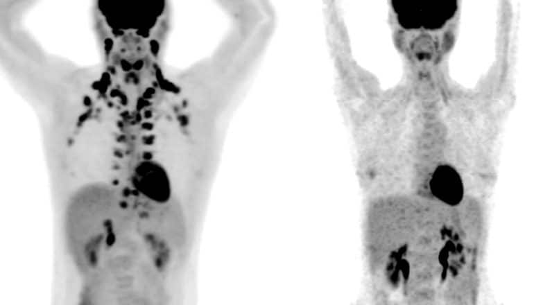 Two PET scans of people side by side