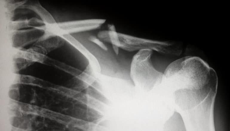 X-ray of broken collarbone