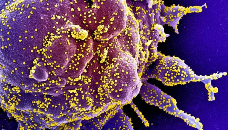 Colorized scanning electron micrograph of an apoptotic cell (purple) heavily infected with SARS-COV-2 virus particles (yellow), isolated from a patient sample