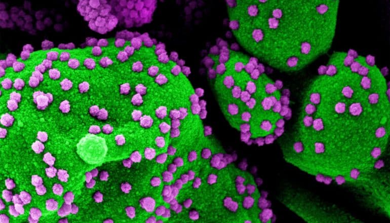 Colorized scanning electron micrograph of an apoptotic cell (green) heavily infected with SARS-COV-2 virus particles (purple), isolated from a patient sample