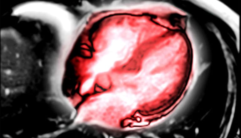 An MRI image with a heart highlighted in red