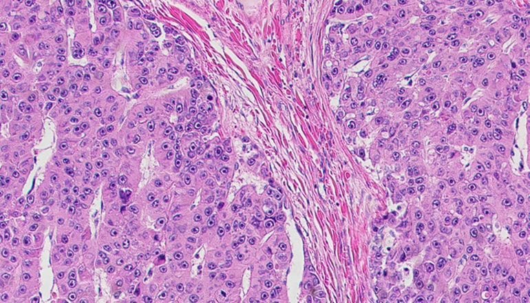 Fibrolamellar tumors cells show up as pink strands within a sea of smaller purple and pink dots