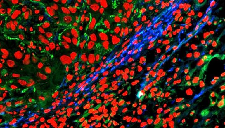 The molecule reveals the tumor boundary, colored blue, with collagen appearing green and cell nuclei showing up red