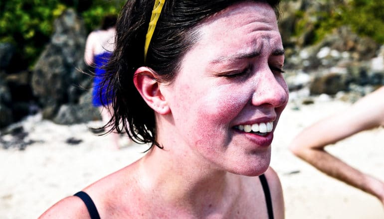 A young woman smiles with her face covered in sunburns and sunscreen