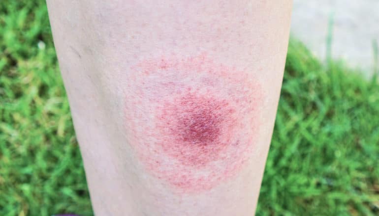 circular rash typical of lyme on leg