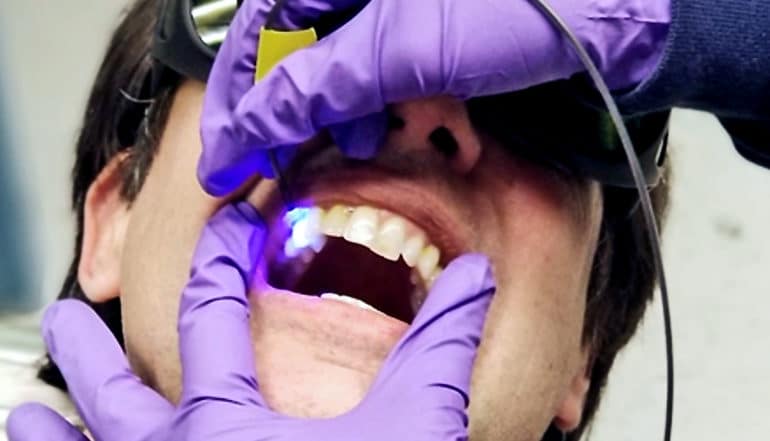 A researcher wearing purple gloves uses the LED light dental tool to examine a man's tooth as he wears goggles and holds his mouth open