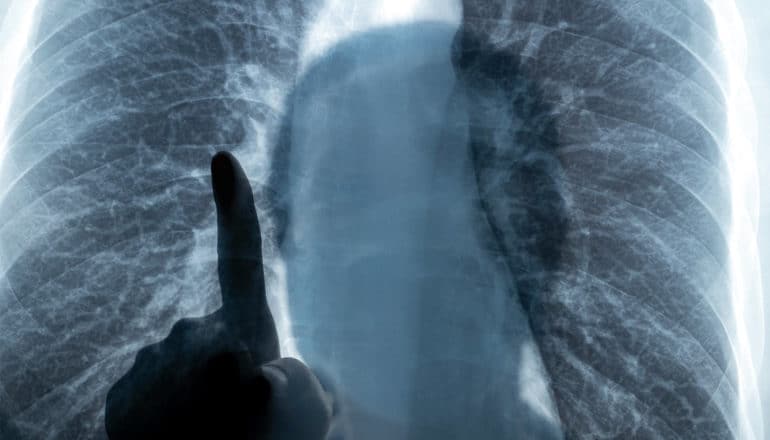 A doctor points at an x-ray scan of lungs