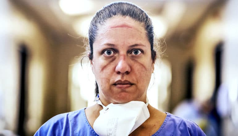 A health care worker looks at the camera with visible bruising on her face from her protective face masks and other gear