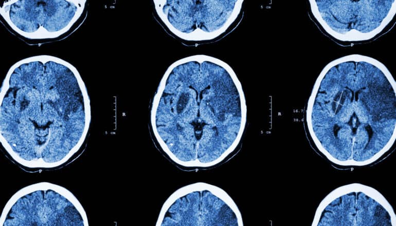 CT scans of brain