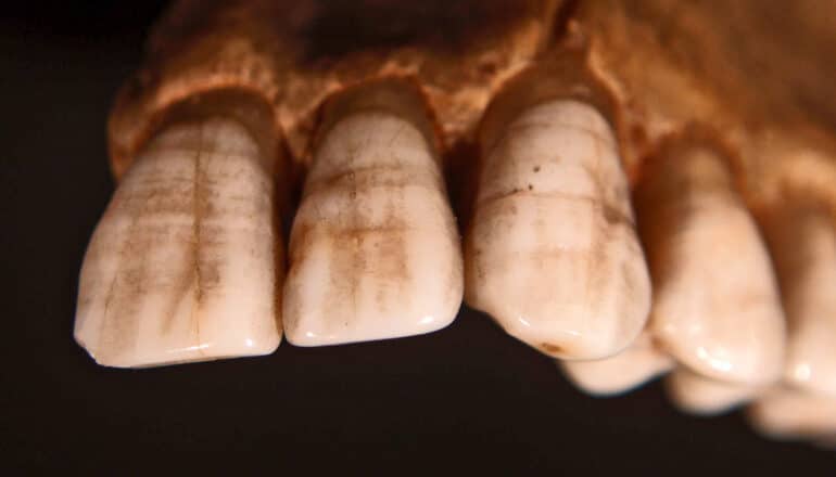 teeth with lines