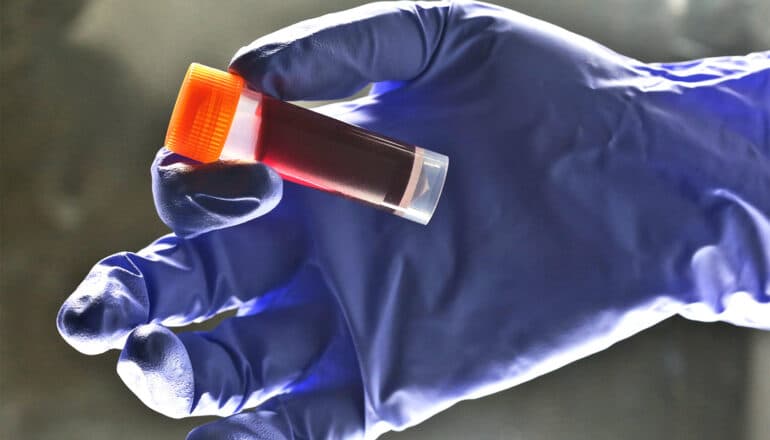 A person wearing a medical glove holds a blood sample in a vial with an orange lid.