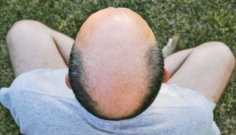 An aerial shot of a bald man sitting on grass.