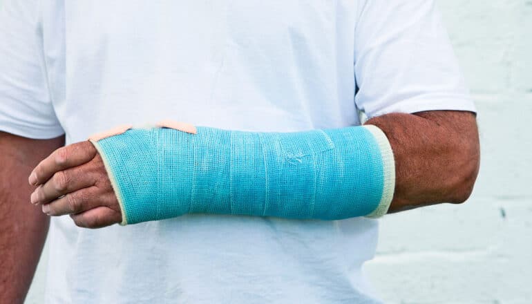 A person wears a blue cast for a bone fracture on their arm.