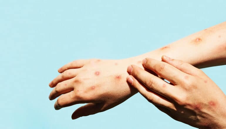 A person scratches their arm, which is covered in small red bumps that look like chickenpox.