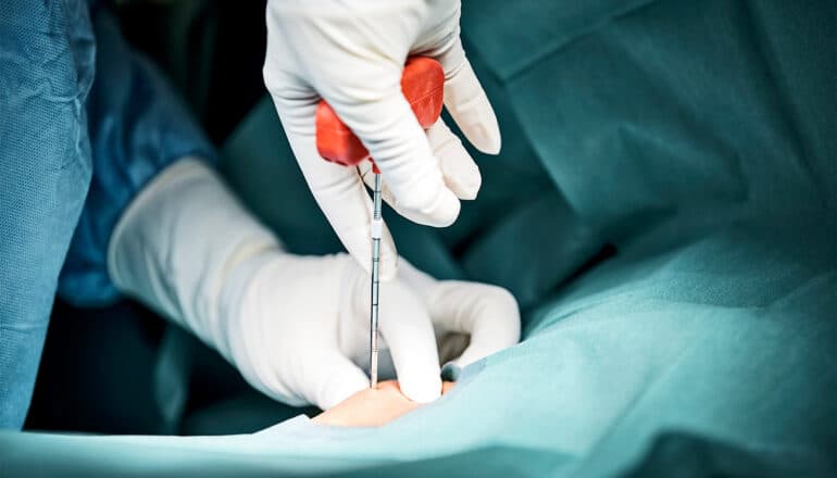 A surgeon wearing white gloves extracts bone marrow from a donor with a large needle.