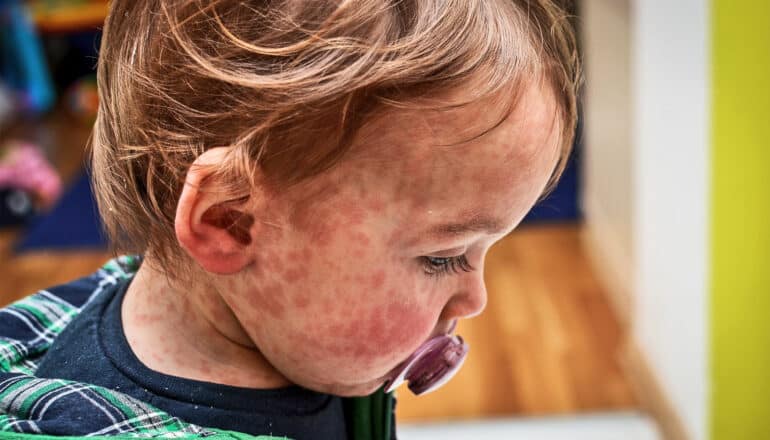 An infant with a red rash on his face sucks a pacifier.