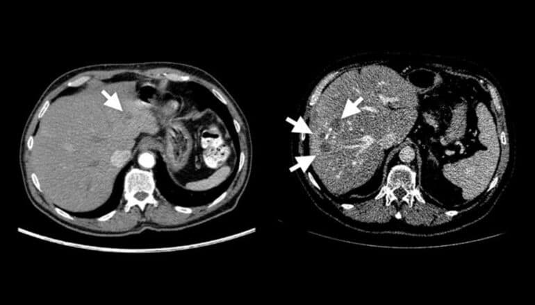 Two abdominal scans side by side show one has a real tumor and the other has several synthetic tumors.