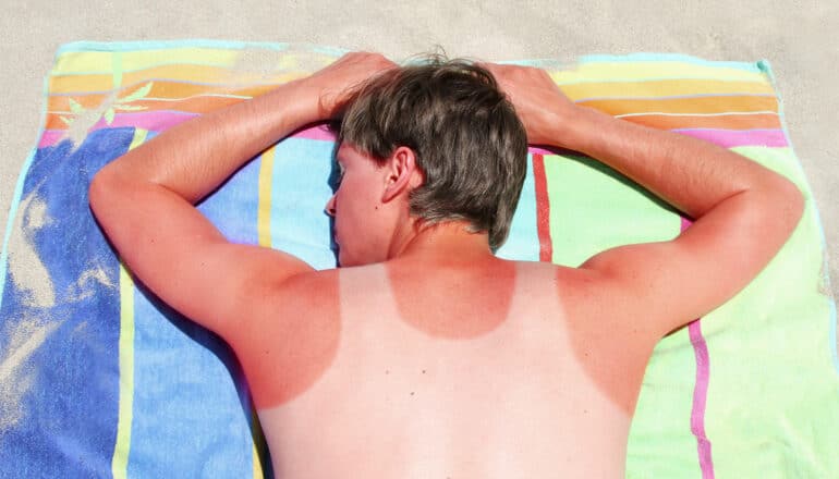 A man laying on a beach towel on sand has a sunburn on his neck and shoulders around where he was wearing a shirt.