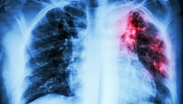 A chest x-ray shows the lungs, with one colored in with red to indicate tuberculosis.