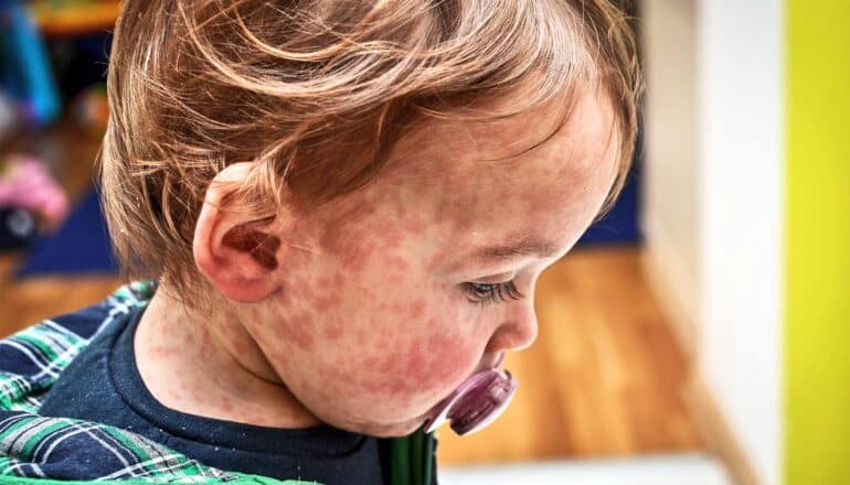 A young child with a pacifier has red measles blemishes on the face and neck.