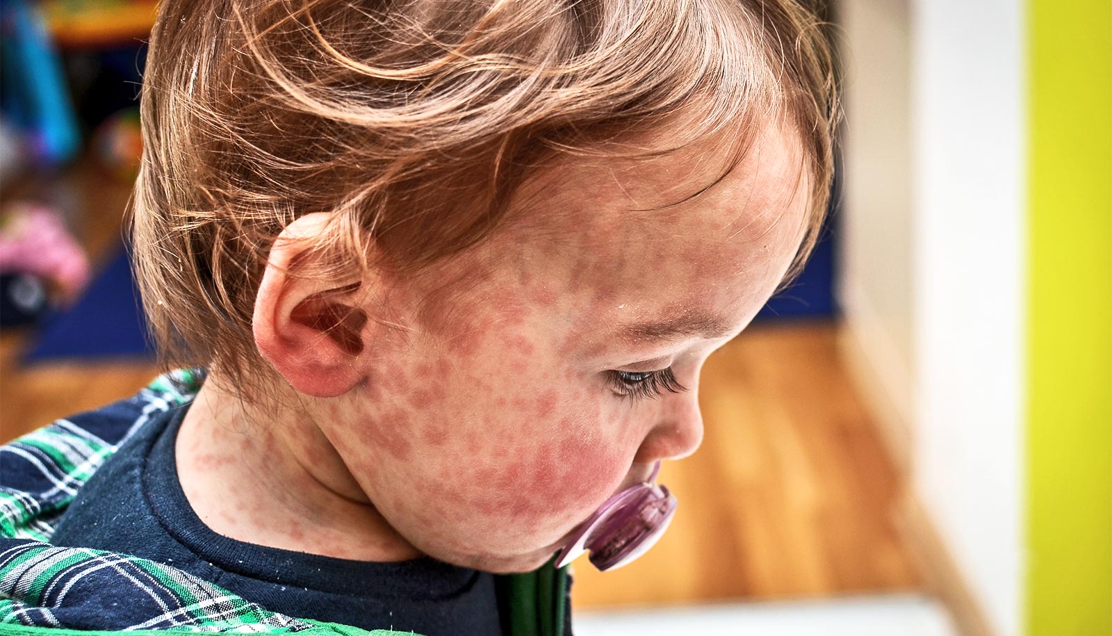 Listen: Why measles is back in the US and what can be done